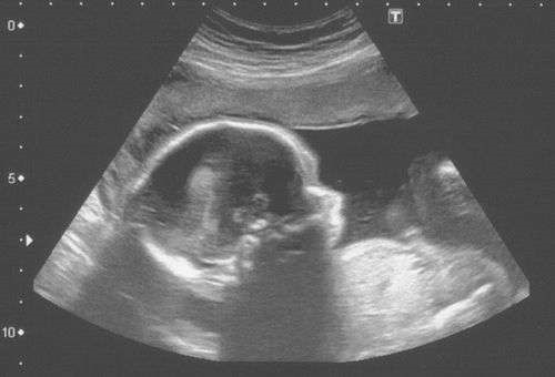 Quais são os direitos do nascituro